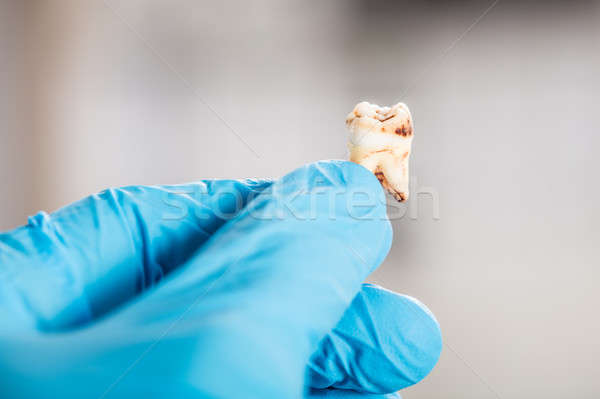 Dentist Hand Holding Decay Tooth Stock photo © AndreyPopov