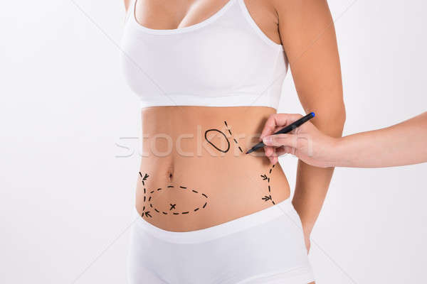 Surgeon Preparing Woman For Liposuction Surgery Stock photo © AndreyPopov