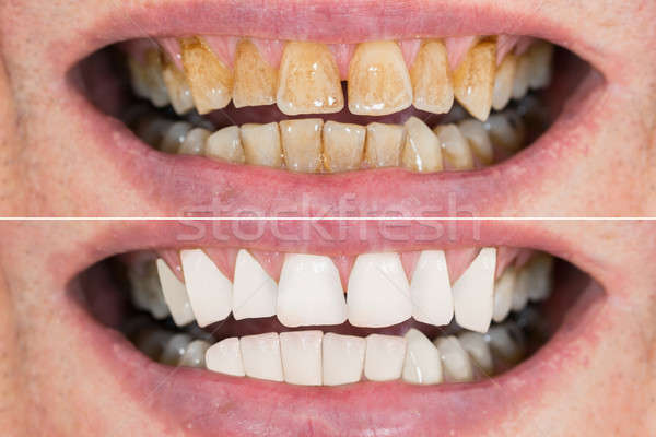 Hombre dientes blanqueo primer plano detalle sonrisa Foto stock © AndreyPopov