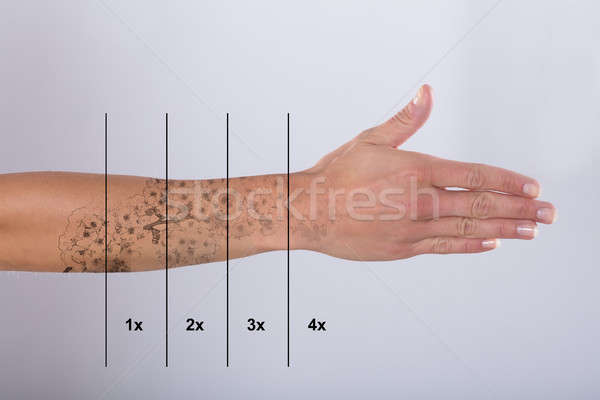 Imagine de stoc: Cu · laser · tatuaj · indepartare · mână · gri · sportiv