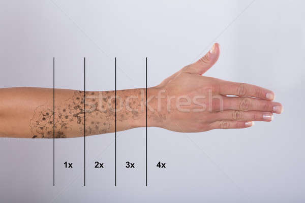 Stock photo: Laser Tattoo Removal On Woman's Hand