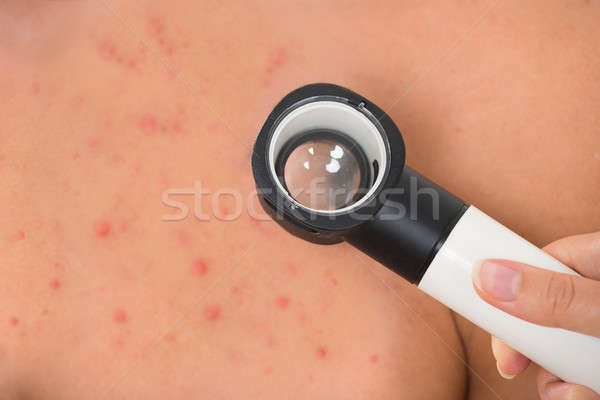 Hand onderzoeken acne huid Stockfoto © AndreyPopov