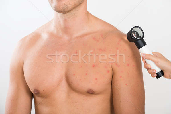 Médico acne pele homem médico jovem Foto stock © AndreyPopov