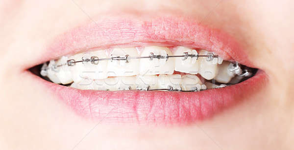 Zähne Hosenträger schönen weiblichen Lächeln Zahnpflege Stock foto © Anna_Om