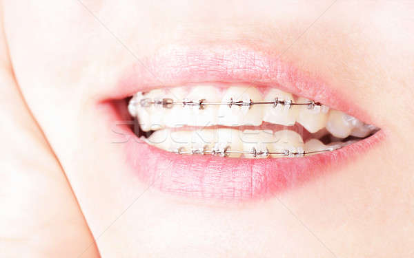 Dientes tirantes hermosa femenino sonrisa atención dental Foto stock © Anna_Om