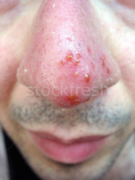 носа холодно медицинской состояние Сток-фото © ArenaCreative