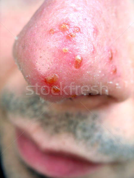 Stock foto: Nase · kalten · wund · medizinischen · Zustand