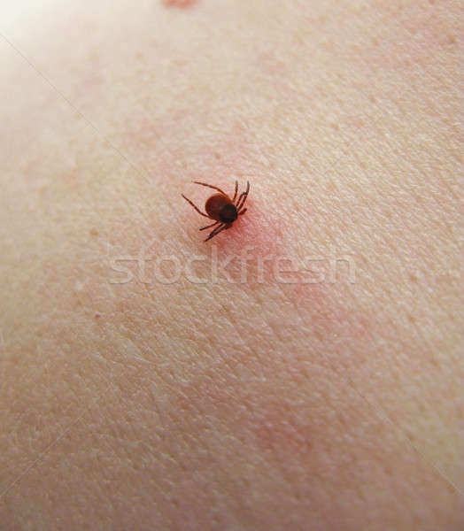 Tick sucking on skin Stock photo © Arrxxx