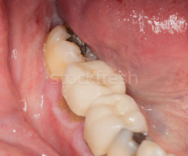Macro image of filled teeth Stock photo © backyardproductions