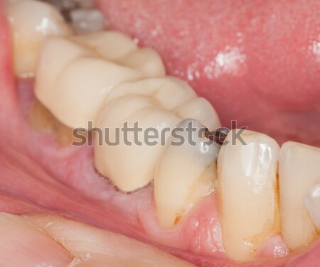 Macro image of filled teeth Stock photo © backyardproductions