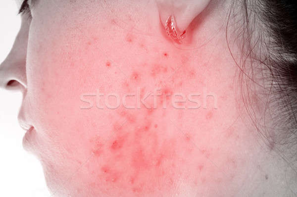 Problems with skin Stock photo © badmanproduction