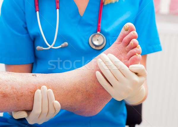 Etkileri dermatolog yaşlı kuru bacak Stok fotoğraf © barabasa