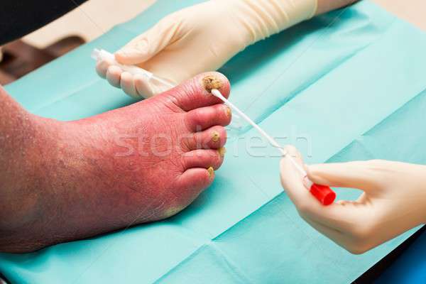 Kezelés szög fertőzés bőrgyógyász elvesz minták Stock fotó © barabasa