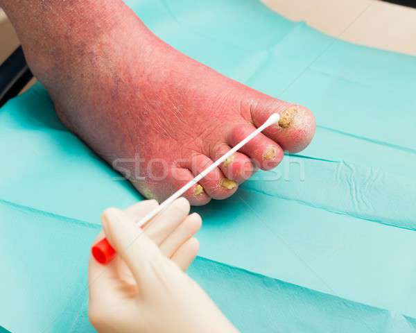 Bőrgyógyászat fertőzés bőrgyógyász megvizsgál öreg szög Stock fotó © barabasa