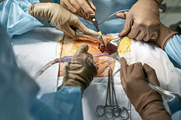 腹部的 手術 過程 外科醫生 激光 解剖刀 商業照片 © bezikus