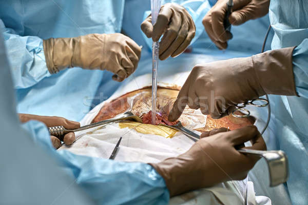 Abdominal operatie proces grup chirurgii Imagine de stoc © bezikus