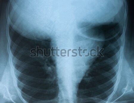 Chest X-ray medical image. Stock photo © borysshevchuk