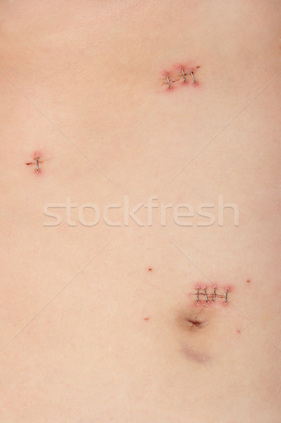 Cirugía médicos piel corte cicatriz operación Foto stock © BVDC