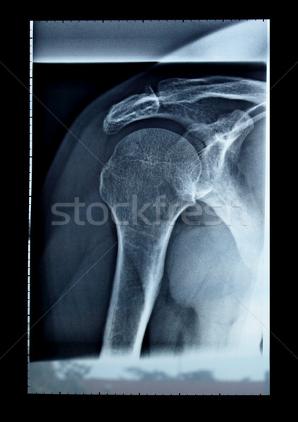 X射線 醫生 肩 使用 診斷 放射線學 商業照片 © claudiodivizia