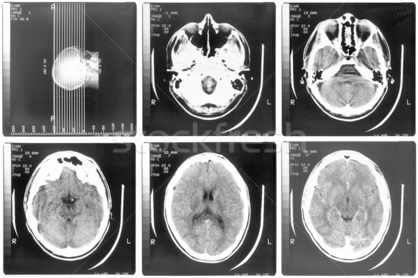 ストックフォト: 医療 · X線 · X線 · 人間の脳 · 頭蓋骨 · 骨