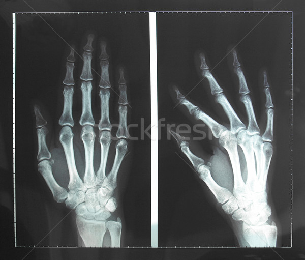 Xray medical mână degete folosit diagnostic Imagine de stoc © claudiodivizia