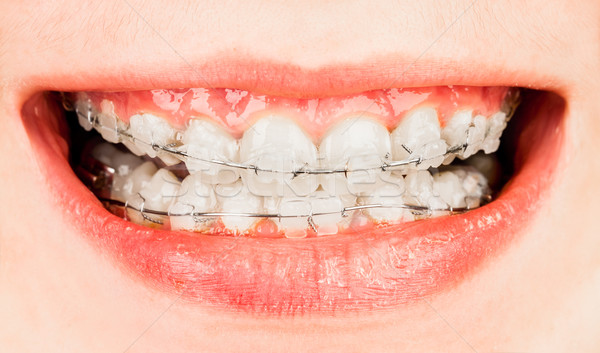 Fogszabályozó fogak fiú ajkak mosolyog nevet Stock fotó © cookelma