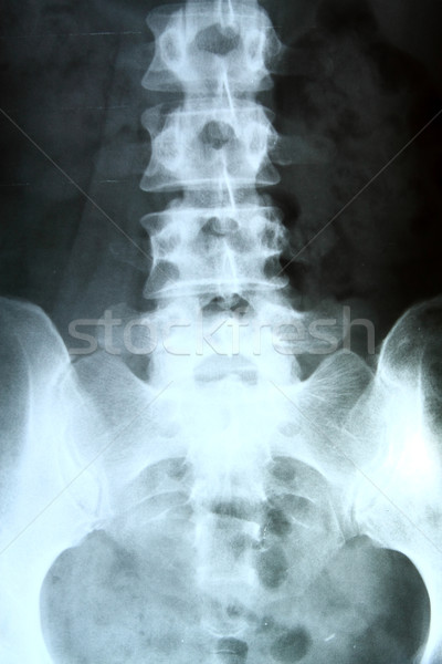 Foto d'archivio: Xray · colonna · vertebrale · donna · medici · film · salute
