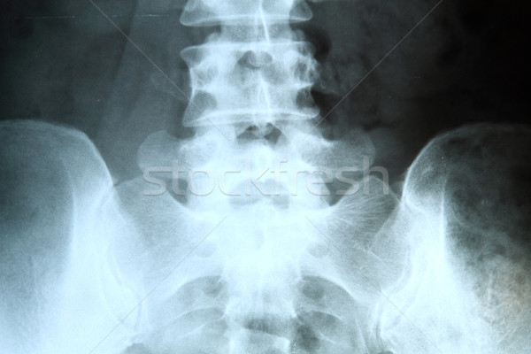 Xray colonna vertebrale donna medici film salute Foto d'archivio © cozyta