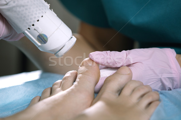 Podiatrist treating onychomycosis with a laser Stock photo © d13
