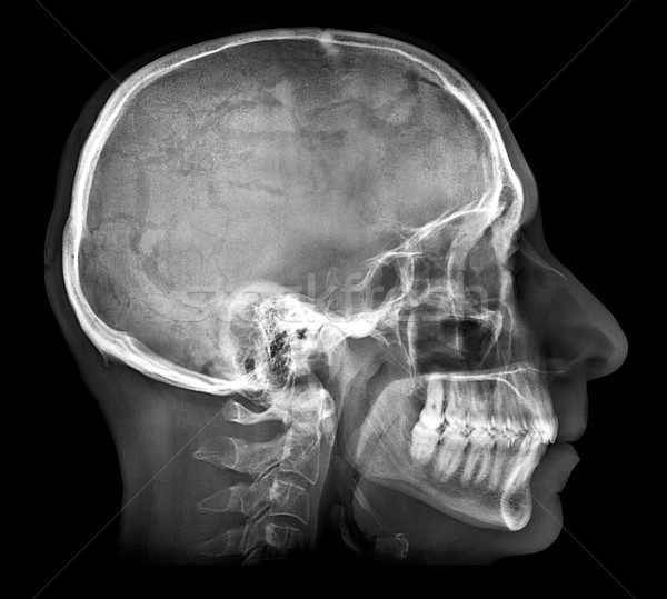 Human skull X-ray image Stock photo © daboost