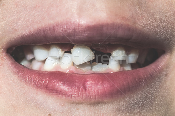 孩子 失去 牙齒 面對 背景 男孩 商業照片 © deyangeorgiev