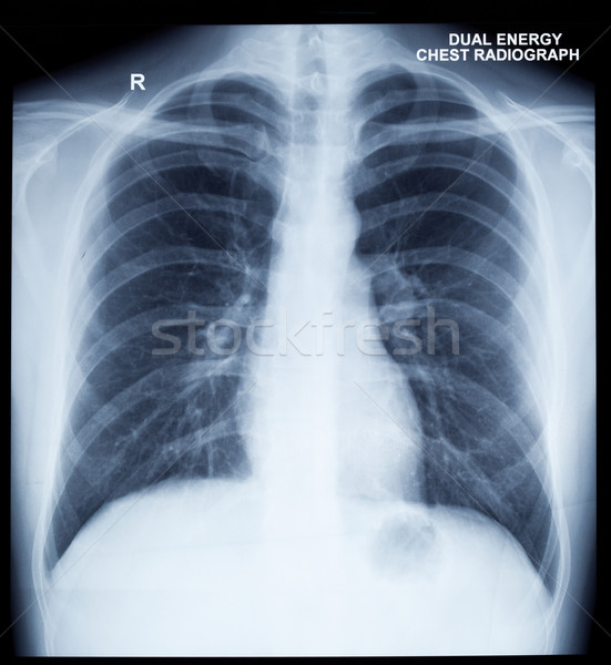 X-Ray Image Of Human Chest Stock photo © dmitry_rukhlenko