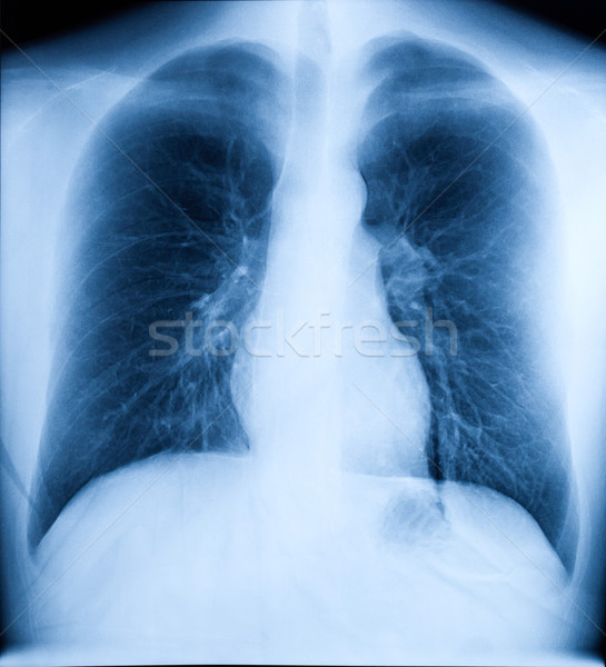 X-Ray Image Of Human Chest Stock photo © dmitry_rukhlenko