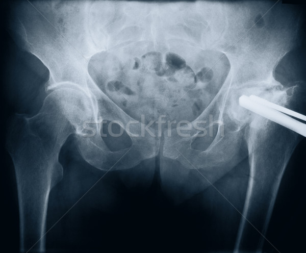 x-ray with bolt Stock photo © donatas1205