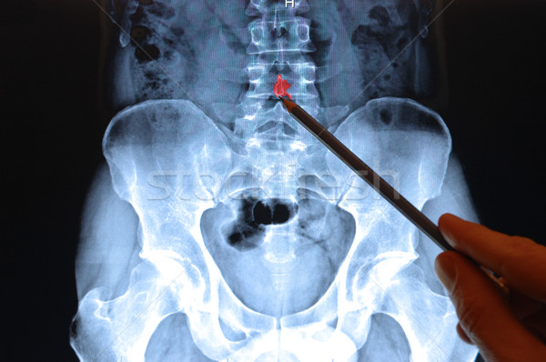 X ray Bild Wirbelsäule Bleistift Punkte heraus Stock foto © dzejmsdin
