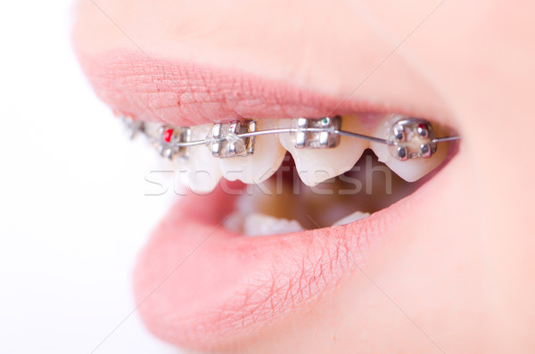 рот фигурные скобки медицинской женщину девушки лице Сток-фото © Elnur