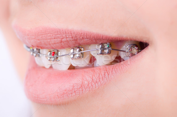 Stock photo: Mouth with brackets braces in medical concept