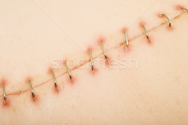 Cicatriz metal primer plano superficial médicos salud Foto stock © Forgiss