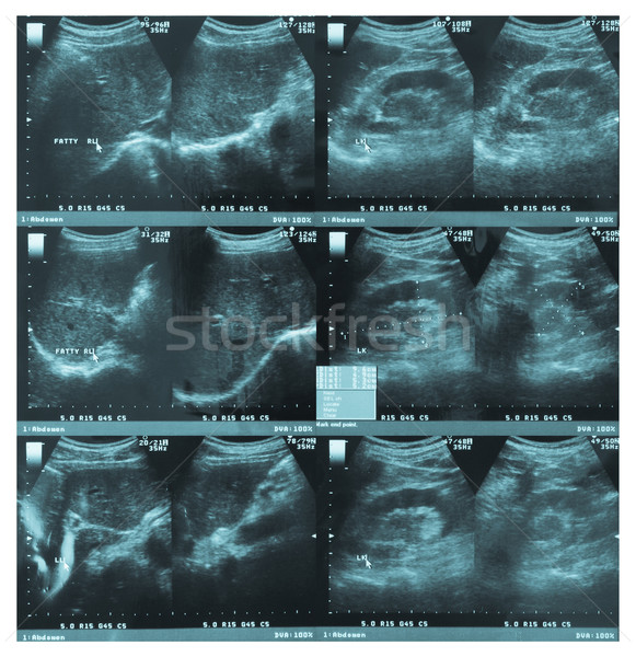 Stock photo: ultrasonography image of abdomen