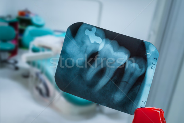 Stock photo: tooth and overlapping teeth in X-ray film showing and tweezer ag