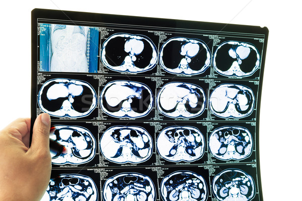 Medical diagnosis background. CT scan and hand Stock photo © FrameAngel