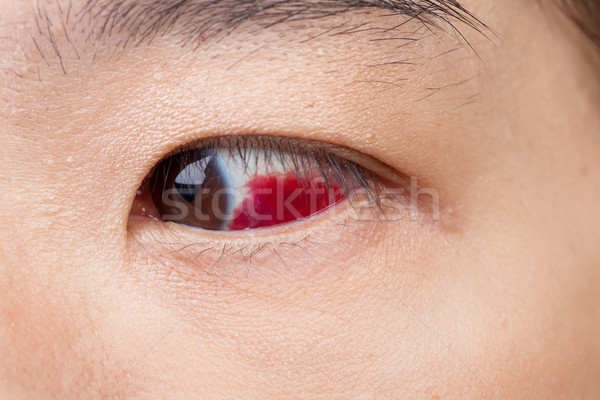 Eye injury or infected for healthy concept, macro closeup  Stock photo © FrameAngel
