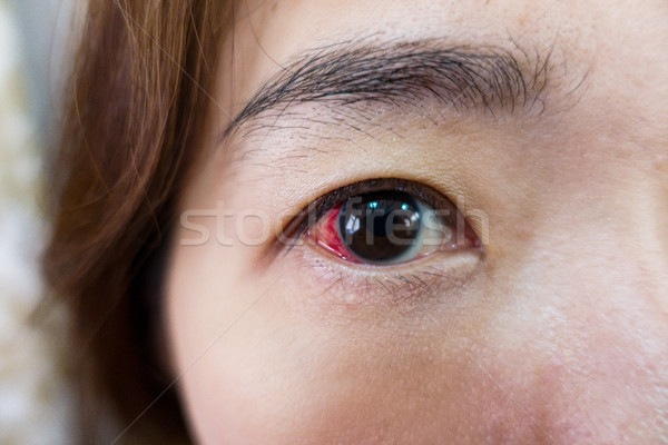Eye injury or infected for healthy concept, macro closeup Stock photo © FrameAngel