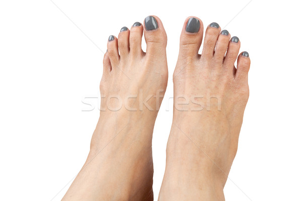 female feet with eczema infect, isolated on white background, cl Stock photo © FrameAngel
