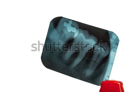tooth and overlapping teeth in X-ray film showing and tweezer on Stock photo © FrameAngel