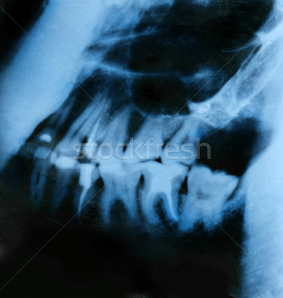 стоматологических Xray подробность медицинской фильма медицина Сток-фото © GekaSkr