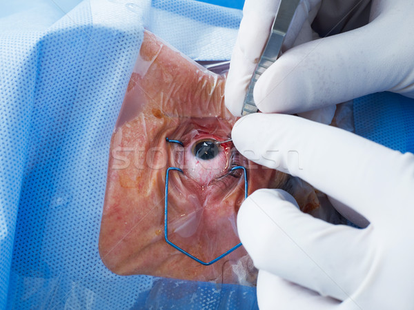 Ochi chirurgie femeie deschide spital Imagine de stoc © goir