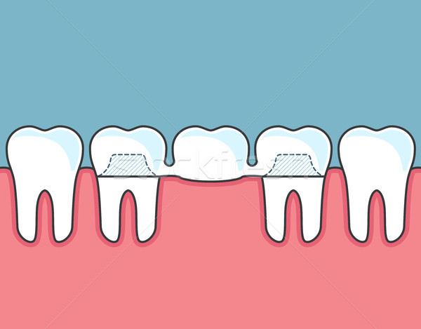 Dentaires pont rangée dents médicaux [[stock_photo]] © gomixer