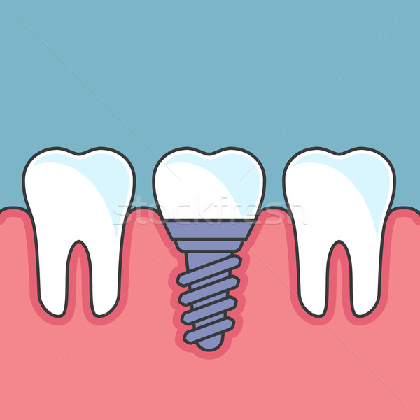 Rząd zęby stomatologicznych implant Zdjęcia stock © gomixer