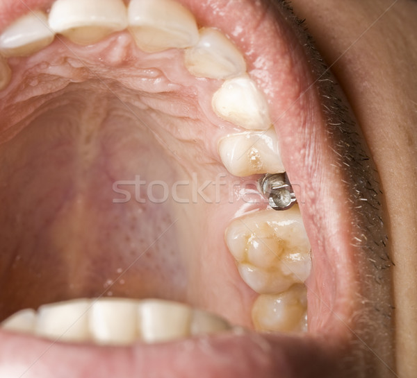 Stomatologie implant gură bărbaţi model dentar Imagine de stoc © grafvision